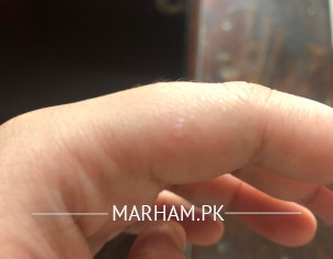 Water Filled Pustules