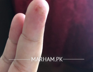 Water Filled Pustules