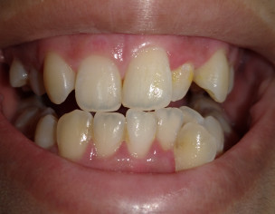 Over Crowded, Over Bitten Teeth