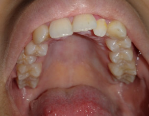 Over Crowded, Over Bitten Teeth