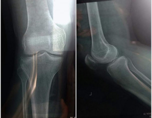 Fracture In Knee And Shoulder