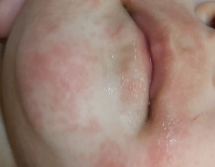 Face Rash