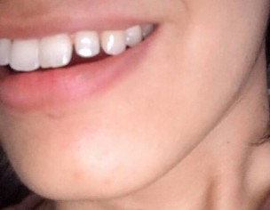 Dentistry. Dentist Teeth Gap Canine Gap Alignment