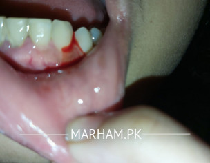 Gum Bleeding