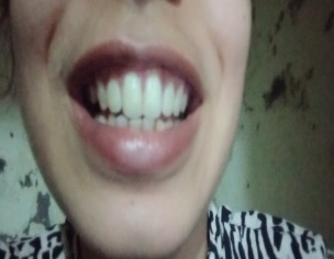 Teeth Trimming