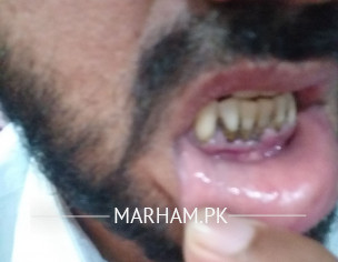 Teeth Problem