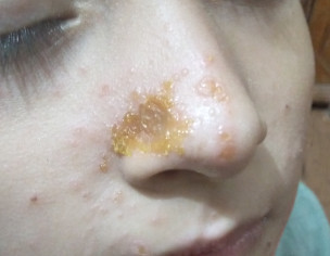 Rash Spots Neat Nose