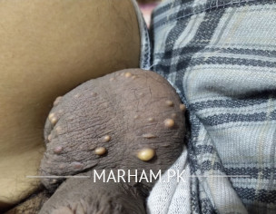 Pimples On Testicles