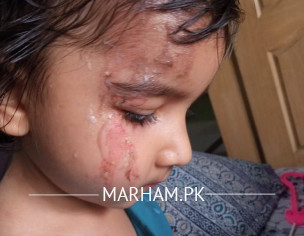 Face Burn With Hot Curry