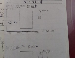 Hearing Loss Solution