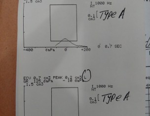 Hearing Loss Solution