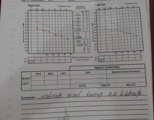 Hearing Loss Solution