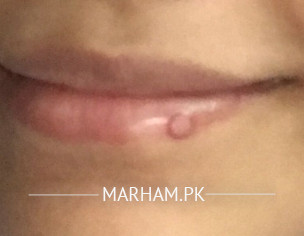 Pimple On Lip