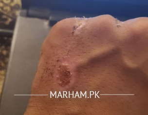 Scars From Road Accident