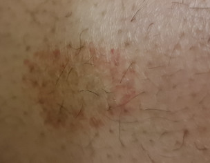 Patch On Lower Leg