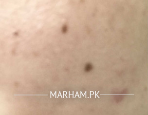 Brown Spots( Dots) On Face