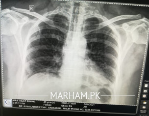 Chest Xray