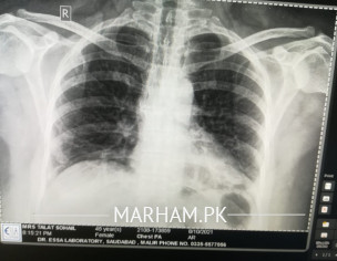 Chest Xray