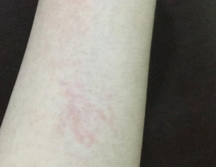 Allergy And Bruise