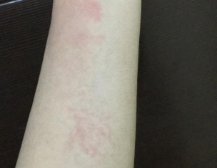 Allergy And Bruise
