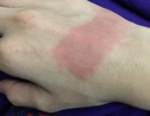 Allergy And Bruise