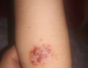 Skin Problem