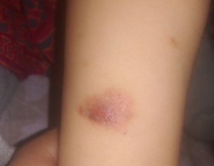 Skin Problem