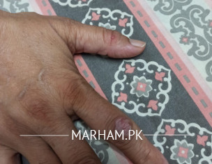 Infection On Knuckles