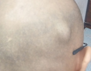 Scalp Nodule