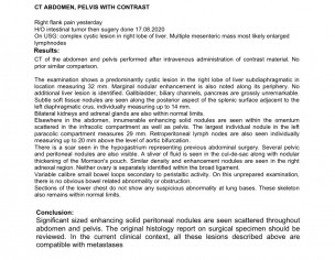 Cyst In Lower Abdomen