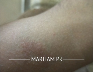 Left Arm Redness Itching