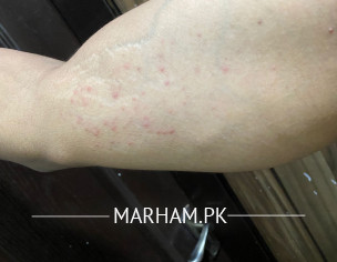 Skin Allergy - Dermatitis