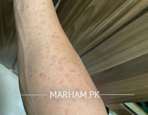 Skin Allergy - Dermatitis