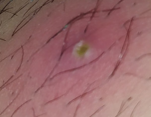 Baltod Or Boil Problem