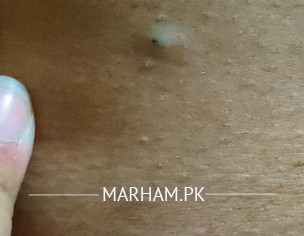 Acne Like Bump With Black Something Inside