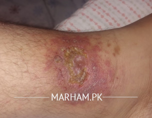 Infection In Left Leg