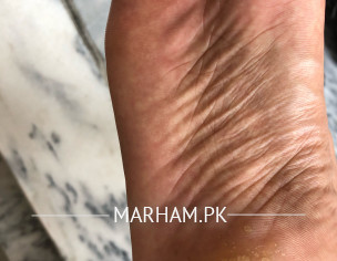 White Wounds On Foot