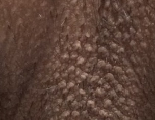 Itch On Above Scrotum Backside