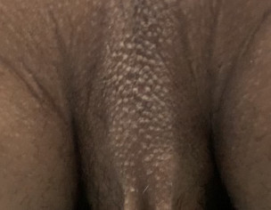 Itch On Above Scrotum Backside