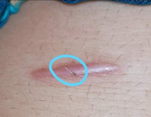 Post Gallbladder Surgery