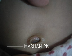 Belly Button Condition