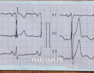Heart Issue, Confused?