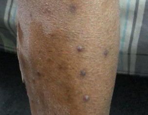 Ckd Patient Skin Related Issue