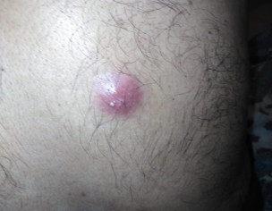 Wound With Normal Pus