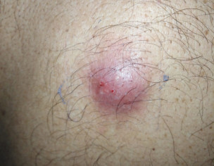 Wound With Normal Pus