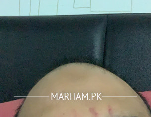 Red Lines On Forehead