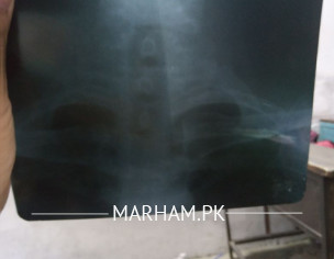 AFTER COVID NECK PROBLEM