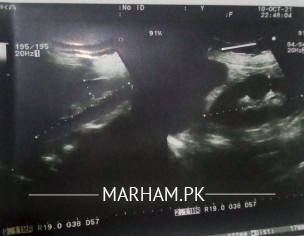 Infection & Diabetes