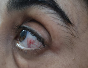 On And Off Redness In Eye