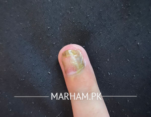 Infected Nail